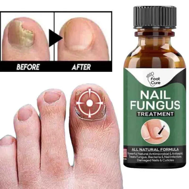 Fast Nail Fungus Treatment Serum – Nail Repair Essence for Finger